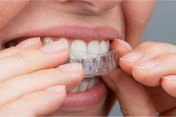 Une fille mettant des aligneurs transparents pour redresser les dents
