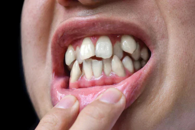 Une personne montrant des dents tordues.