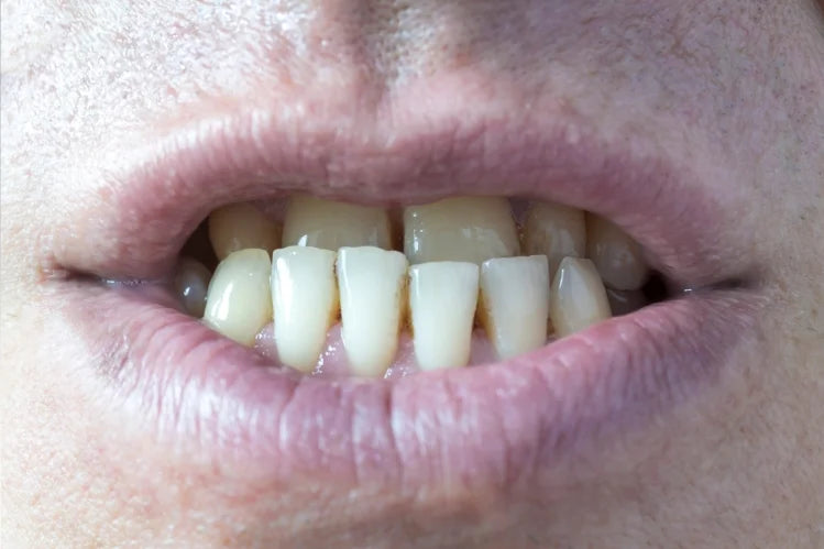 underbite