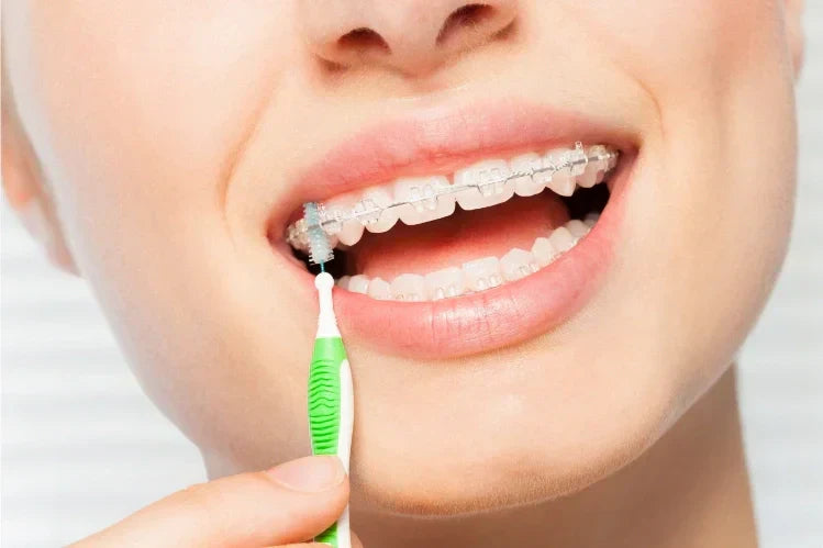 Une fille utilise une brosse interdentaire à poils doux pour nettoyer un appareil dentaire en céramique