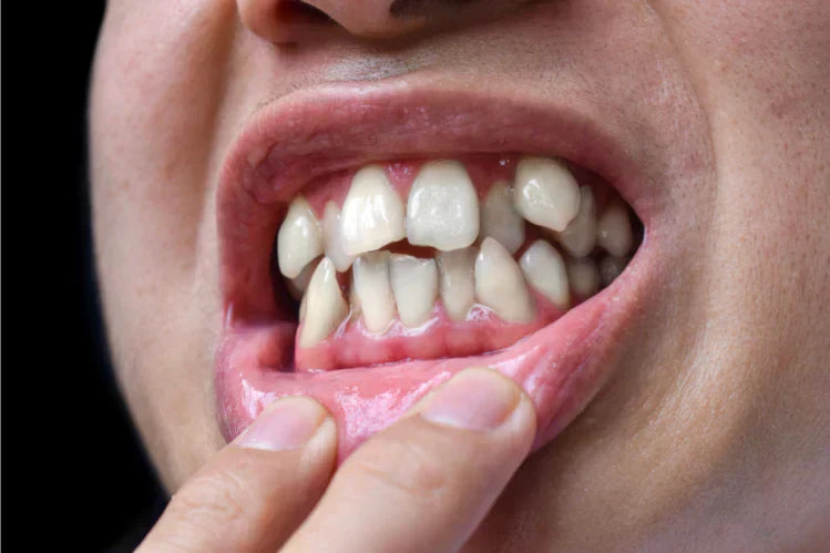 Gros plan de dents bancales