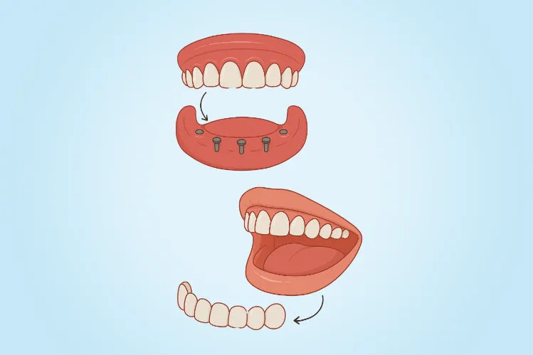 Illustration des facettes et des prothèses dentaires à clipser