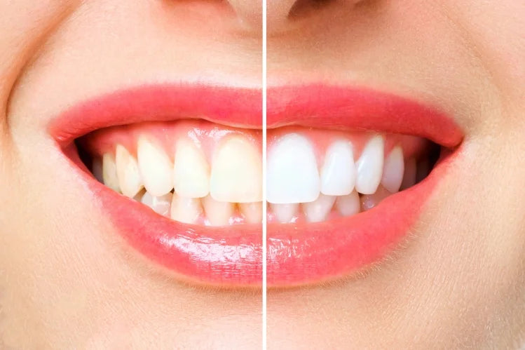 Blanchiment des dents avant et après.