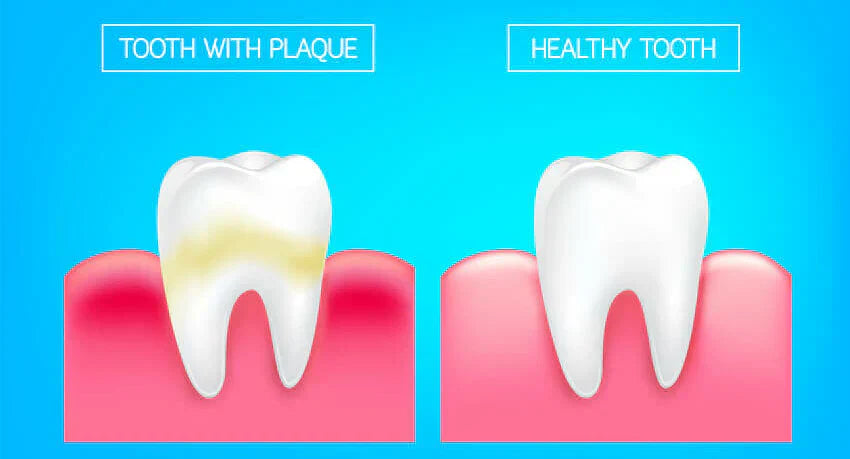 Illustration d'une comparaison entre une dent saine et une dent avec plaque dentaire