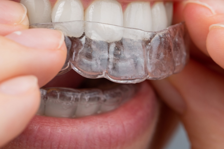 girl putting an clear aligners