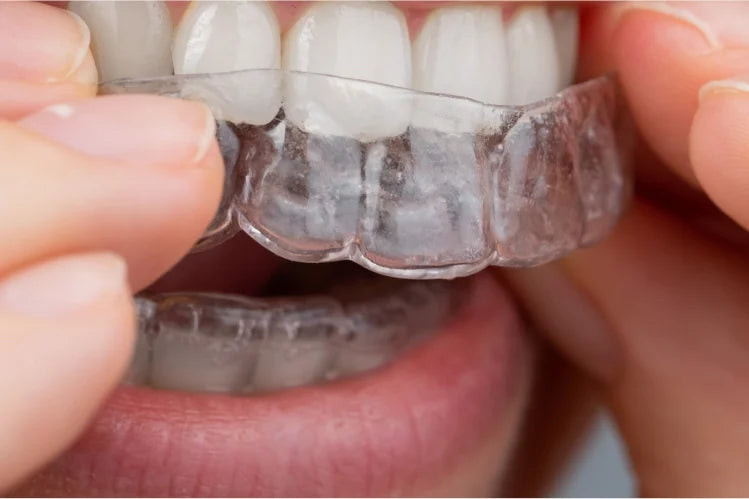 A girl putting on clear aligners 