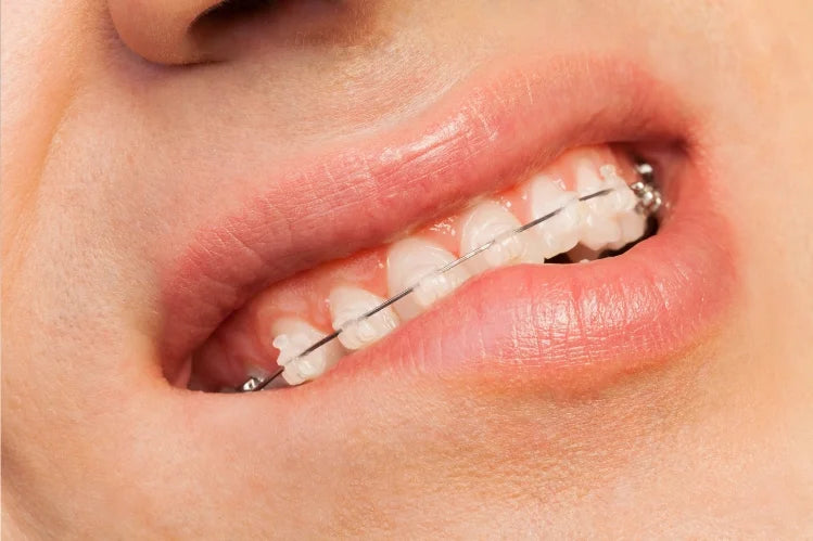 orthodontic bite correction.