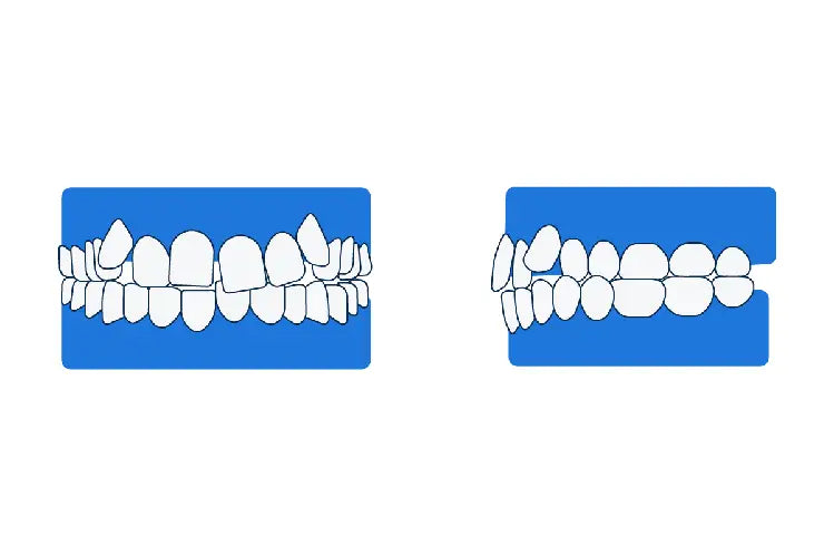 Une illustration de dents tordues