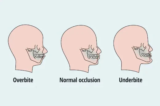 image d'une surocclusion, d'une occlusion normale et d'une sous-occlusion