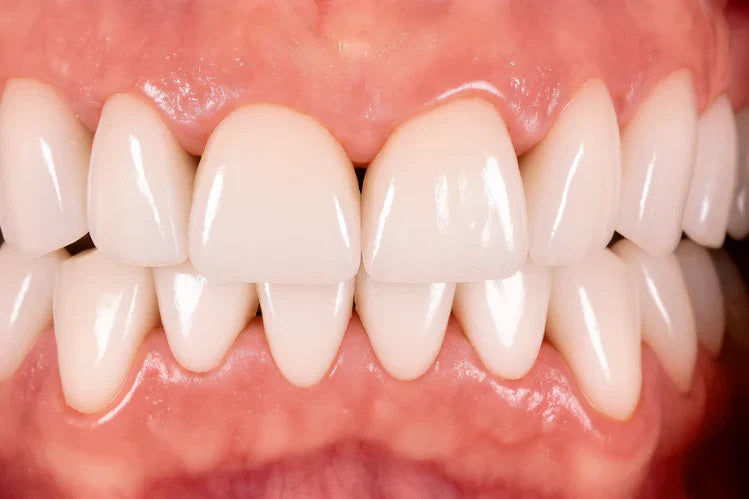 Gros plan sur ce à quoi ressemblent les triangles noirs entre les dents.
