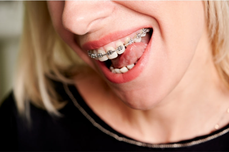 A woman with metal braces