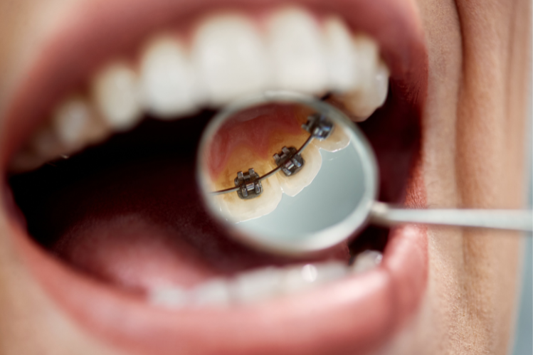 Une femme souriante avec une morsure de classe I.