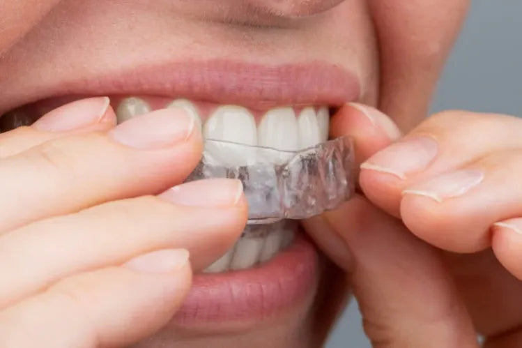 Une jeune fille qui applique des aligneurs transparents pour redresser ses dents à domicile.