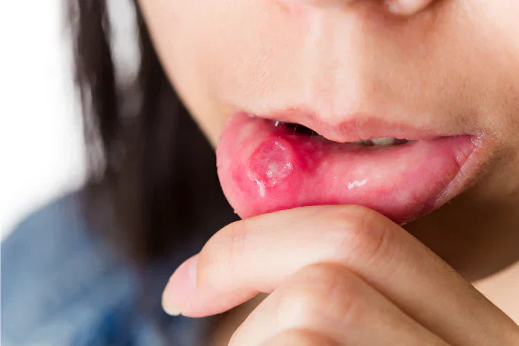 Une personne présentant des aphtes sur la face interne de la lèvre