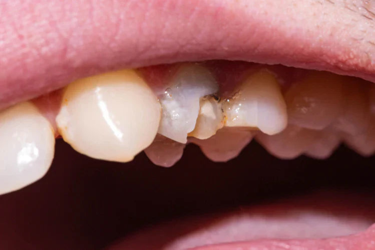 Image d'une dent morte dont l'émail est ébréché.
