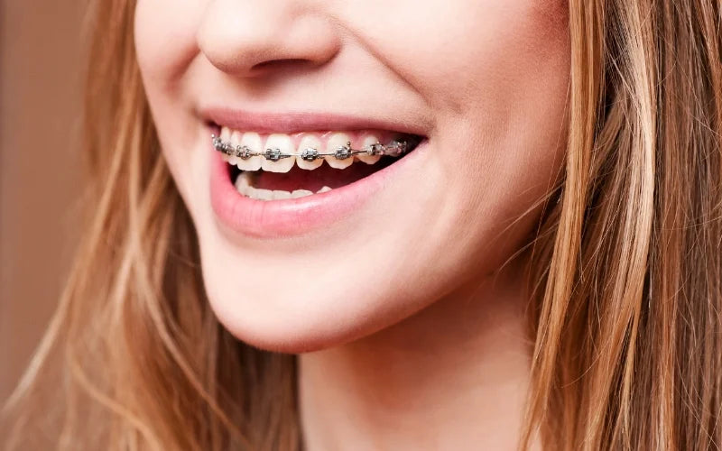 Une jeune fille souriant avec un appareil dentaire métallique