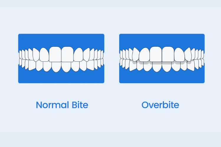 Illustration montrant côte à côte une occlusion normale et une surocclusion.