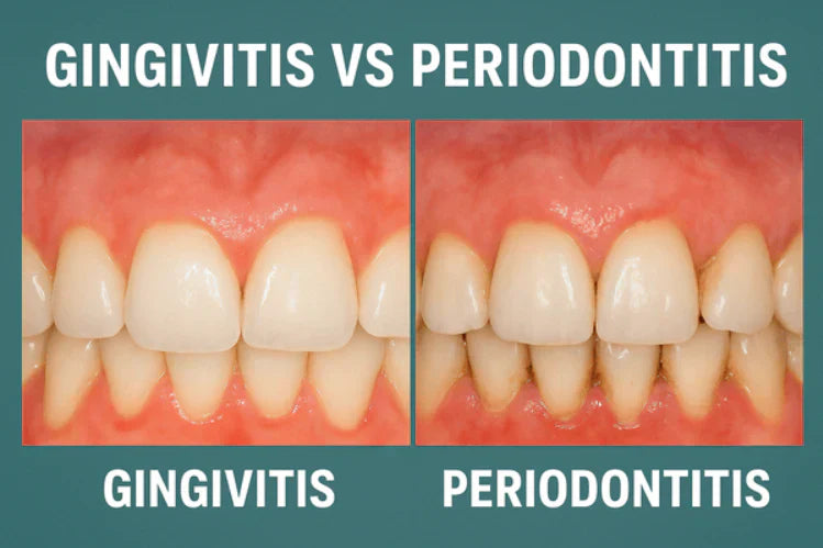 Comparaison côte à côte de la gingivite et de la parodontite