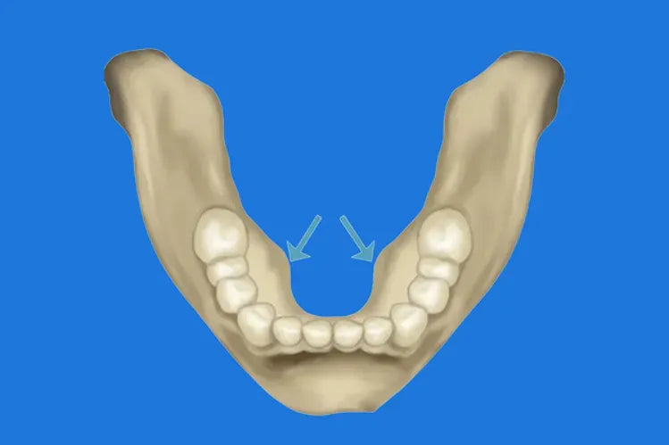 Torus mandibularis : Comprendre les excroissances osseuses dans la bouche