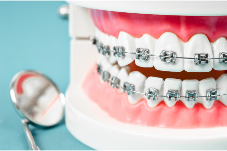 tooth model with metal wire dental braces and a dental mirror on the side