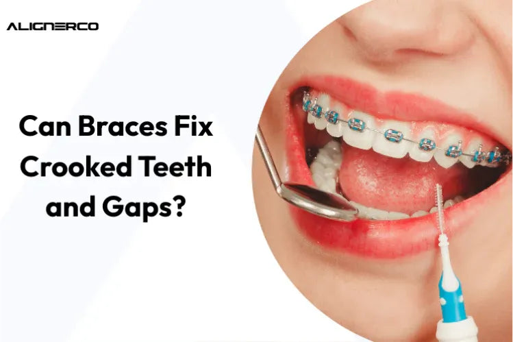 Une jeune fille portant un appareil dentaire en métal coloré pour redresser ses dents.