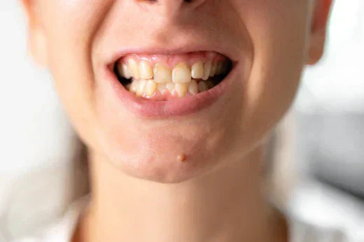 Femme avec malocclusion.