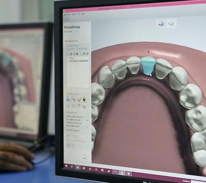 CouplesAdvantage - NightOnly Clear Aligners